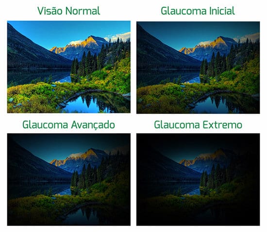 Controle do glaucoma - estágios
