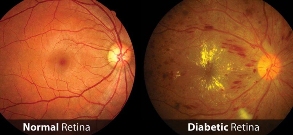 prevenção de doenças oculares