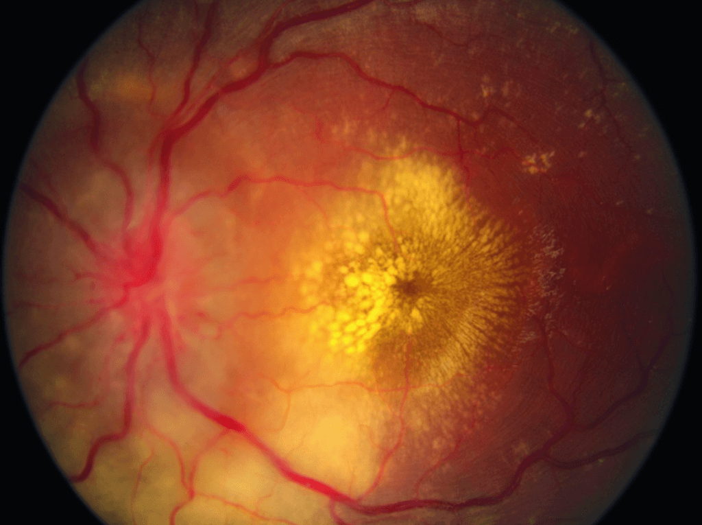 retinopatia hipertensiva