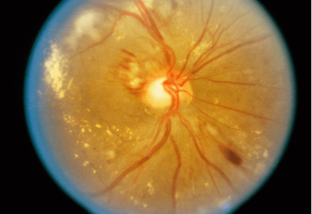 retinopatia hipertensiva