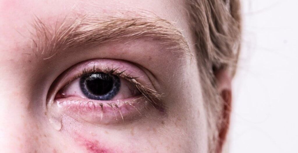 alergia ocular em crianças e adolescentes