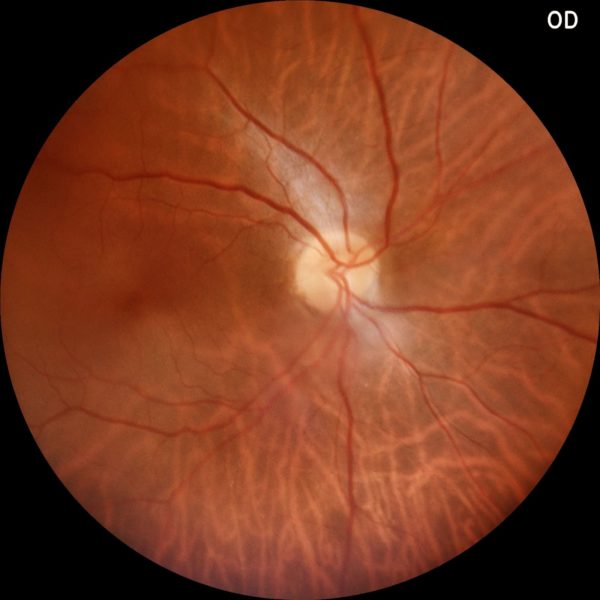 Retinografia colorida realizada com o retinógrafo portátil Eyer da Phelcom Technologies.