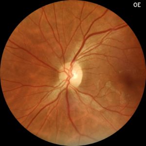retina colorretina color com o retinógrafo Eyer