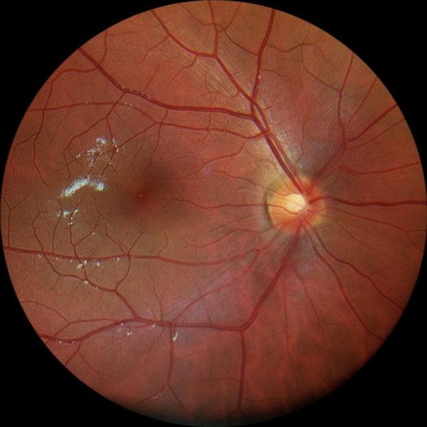Retinografia colorida realizada com o retinógrafo portátil Eyer da Phelcom Technologies.