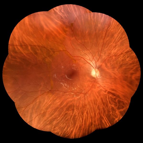 Retinografia colorida panorâmica realizada com o retinógrafo portátil Eyer da Phelcom utilizando 9 pontos de fixação.