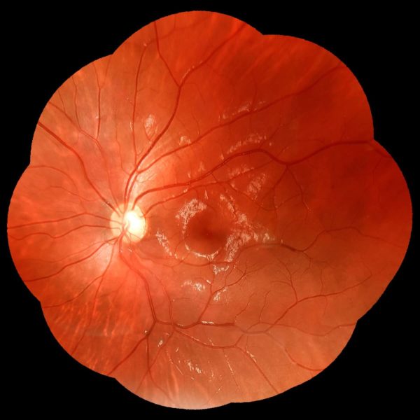 Retinografia colorida panorâmica realizada com o retinógrafo portátil Eyer da Phelcom utilizando 9 pontos de fixação.