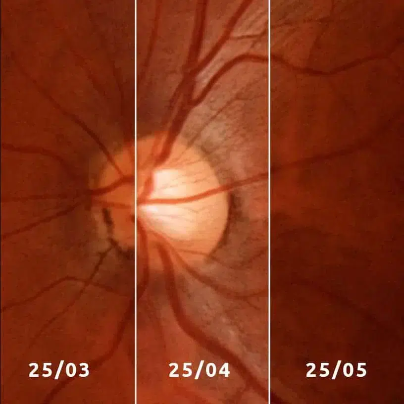 Img Eyerplus Pacient Progression.jpg