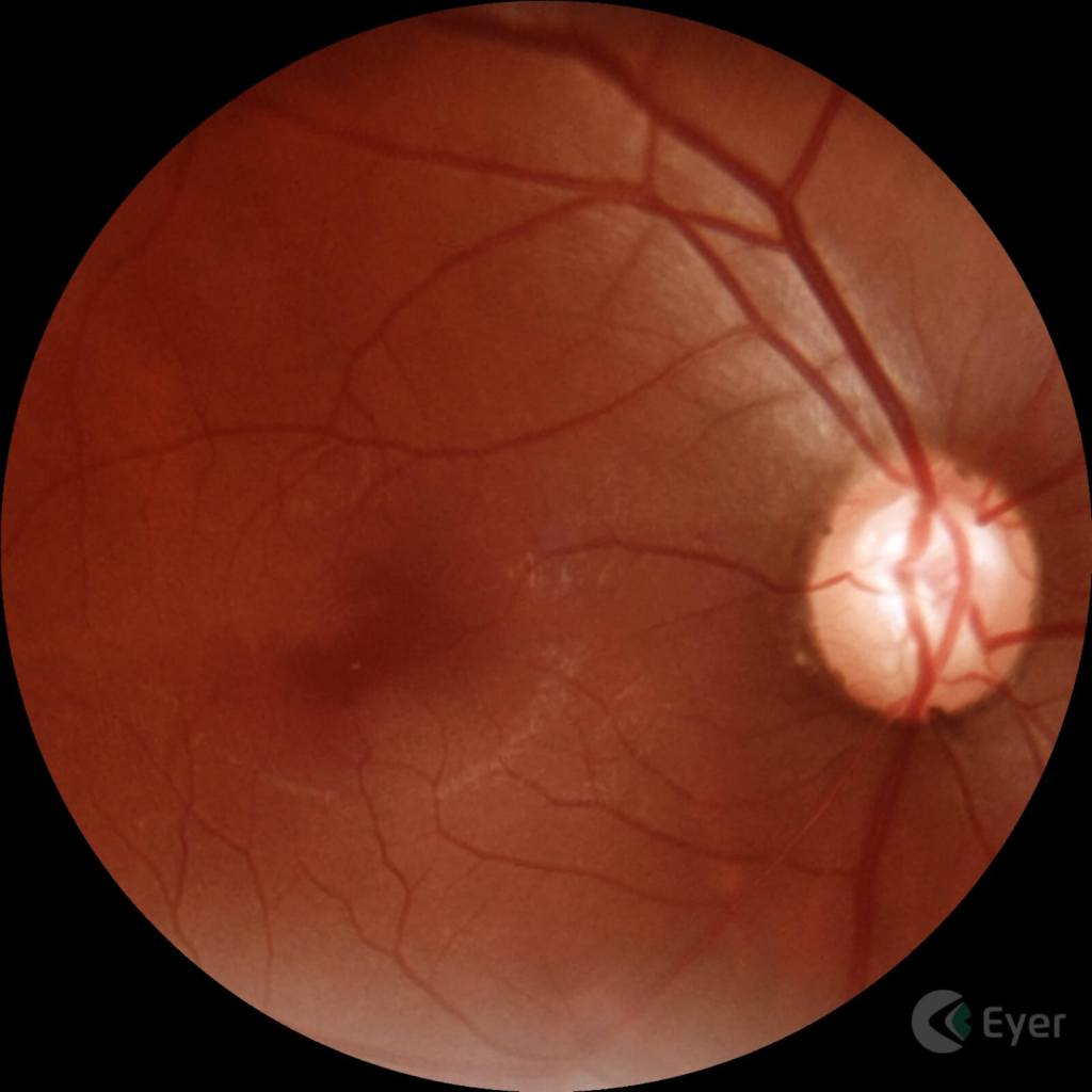 Imagem feita com o Eyer de um paciente diagnosticado com glaucoma. 