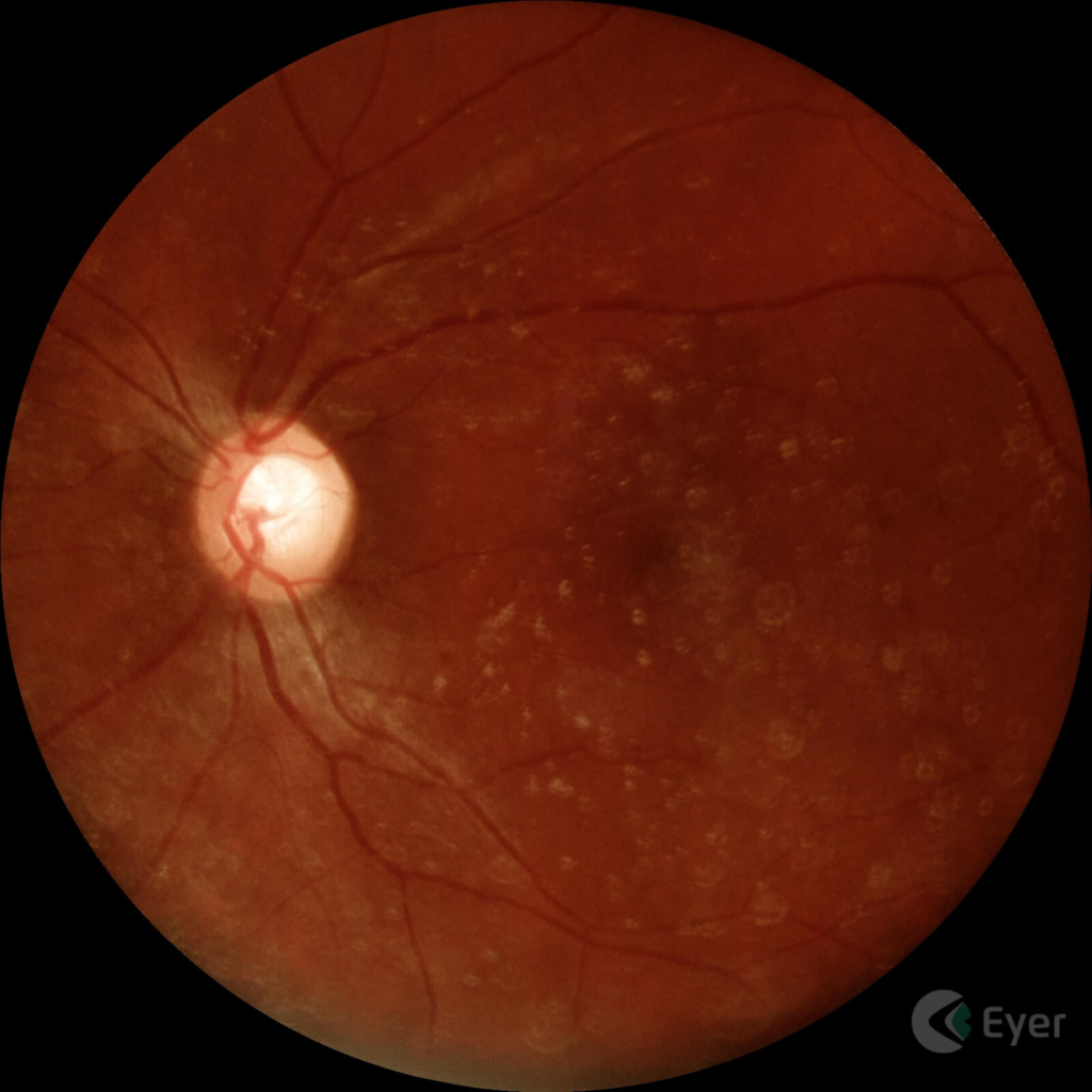 Imagem feita com o Eyer de um paciente diagnosticado com glaucoma. 