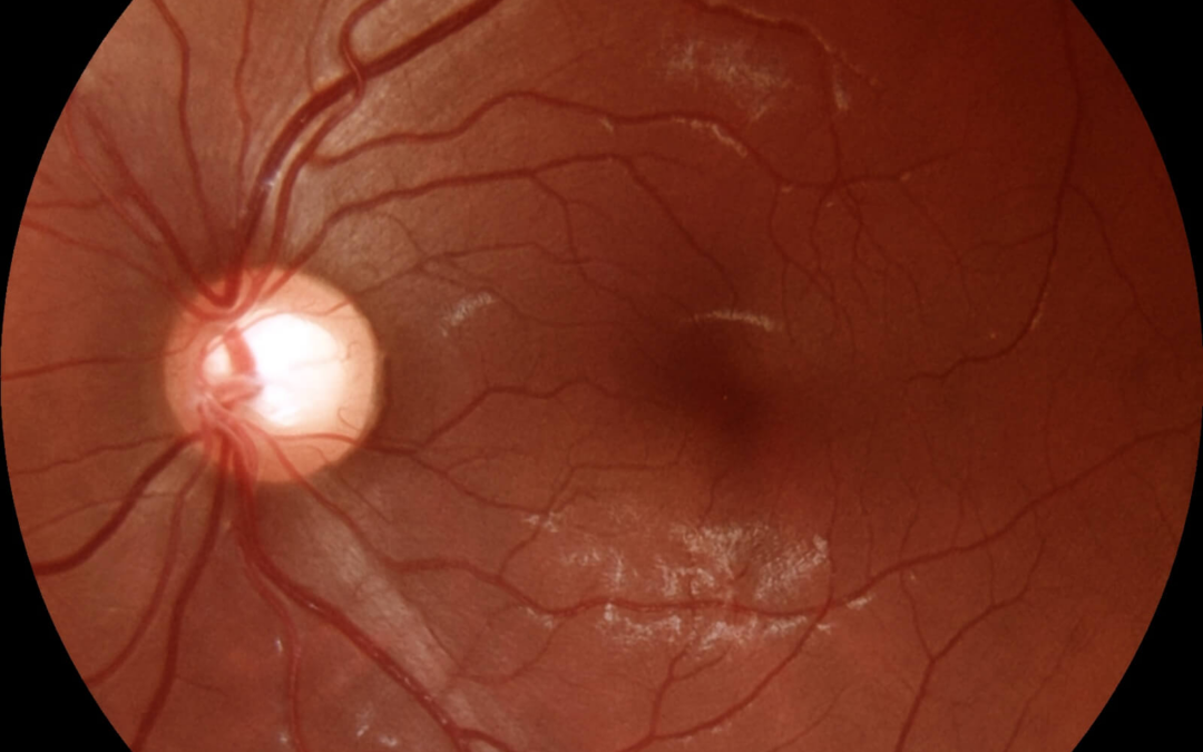 “A retinografia é imprescindível para o diagnóstico de glaucoma”, afirma o oftalmologista e pesquisador Fábio Lavinsky