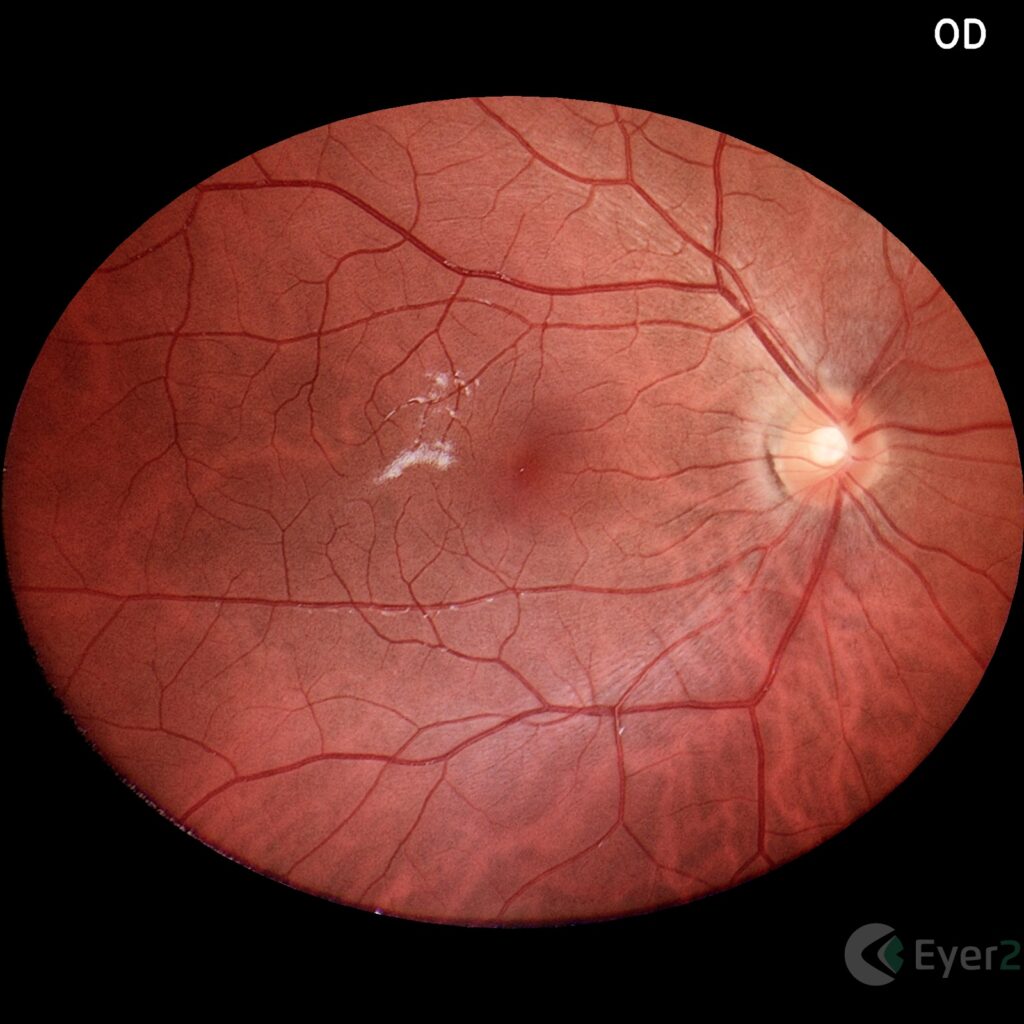 Img Retina Eyer2