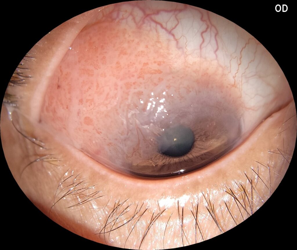 Img Neoplasia Escamosa De Conjuntiva Pre Operatório Eyer2