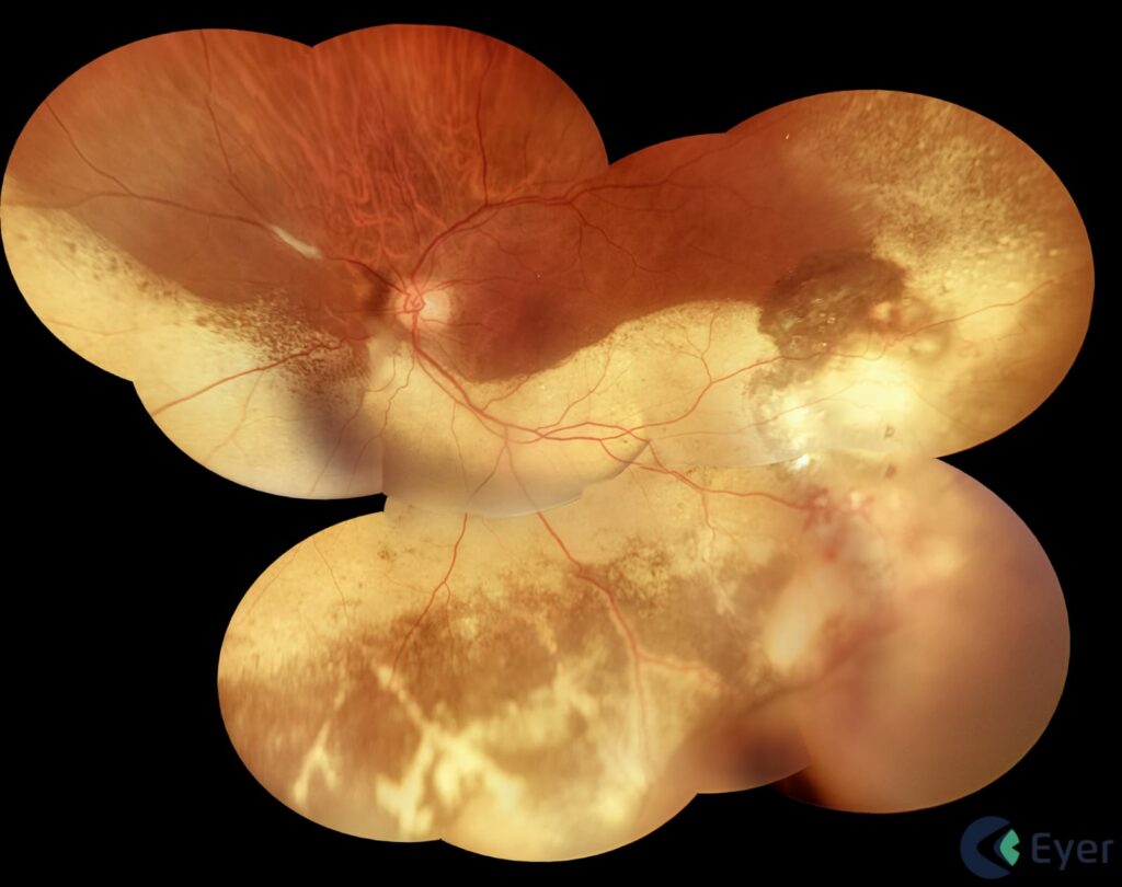 Img Tumor Vasoproliferativo De Retina Eyer2