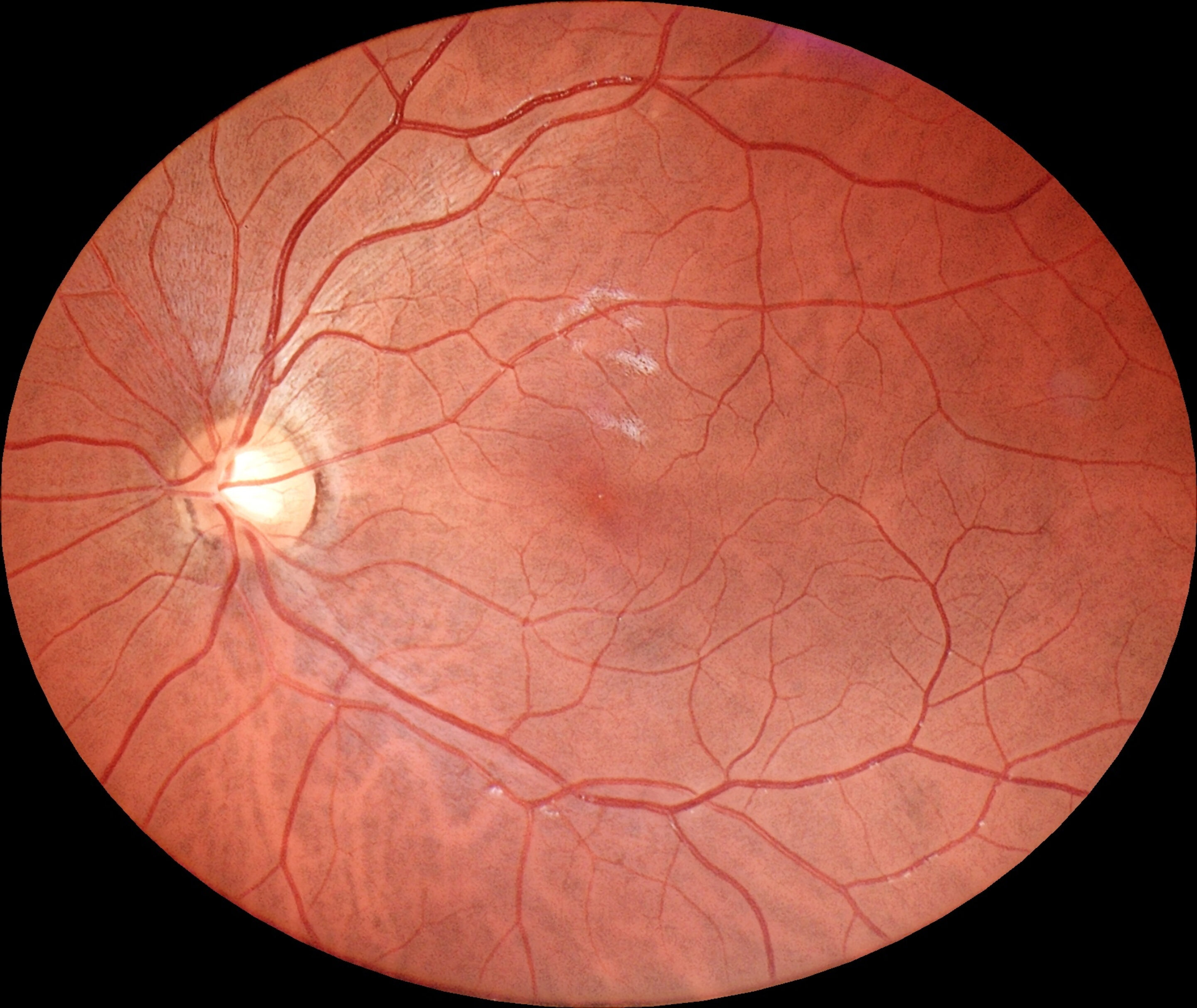 img-retina_by-eyer2-fundus-camera Retina exam captured by Eyer2 fundus camera