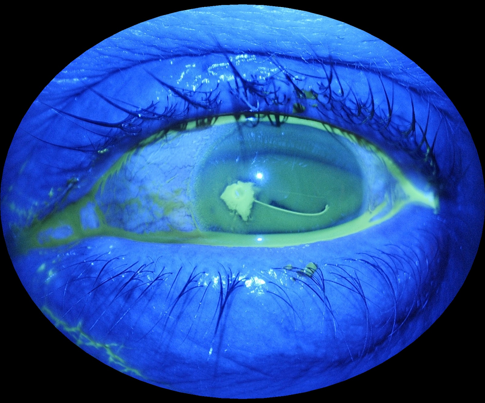 img_cobalt_light_eyer2_fundus_camera Cobalt light captured with Eyer2 fundus camera