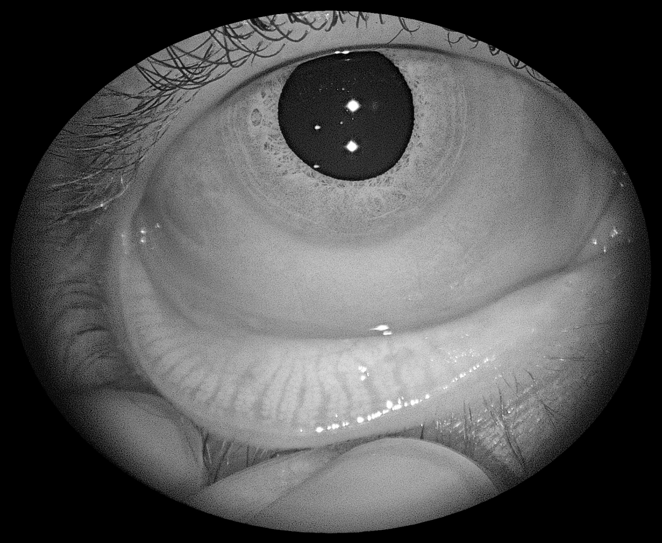 img_meibography_eyer2_fundus_camera Meibography captured with Eyer2 fundus camera.