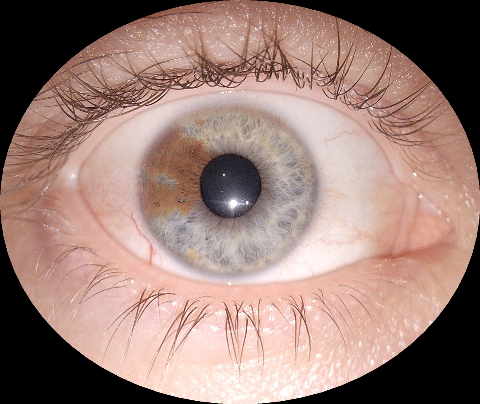 img_ocular_surface_by_eyer2_fundus_camera Ocular surface exam captured by Eyer2 fundus camera