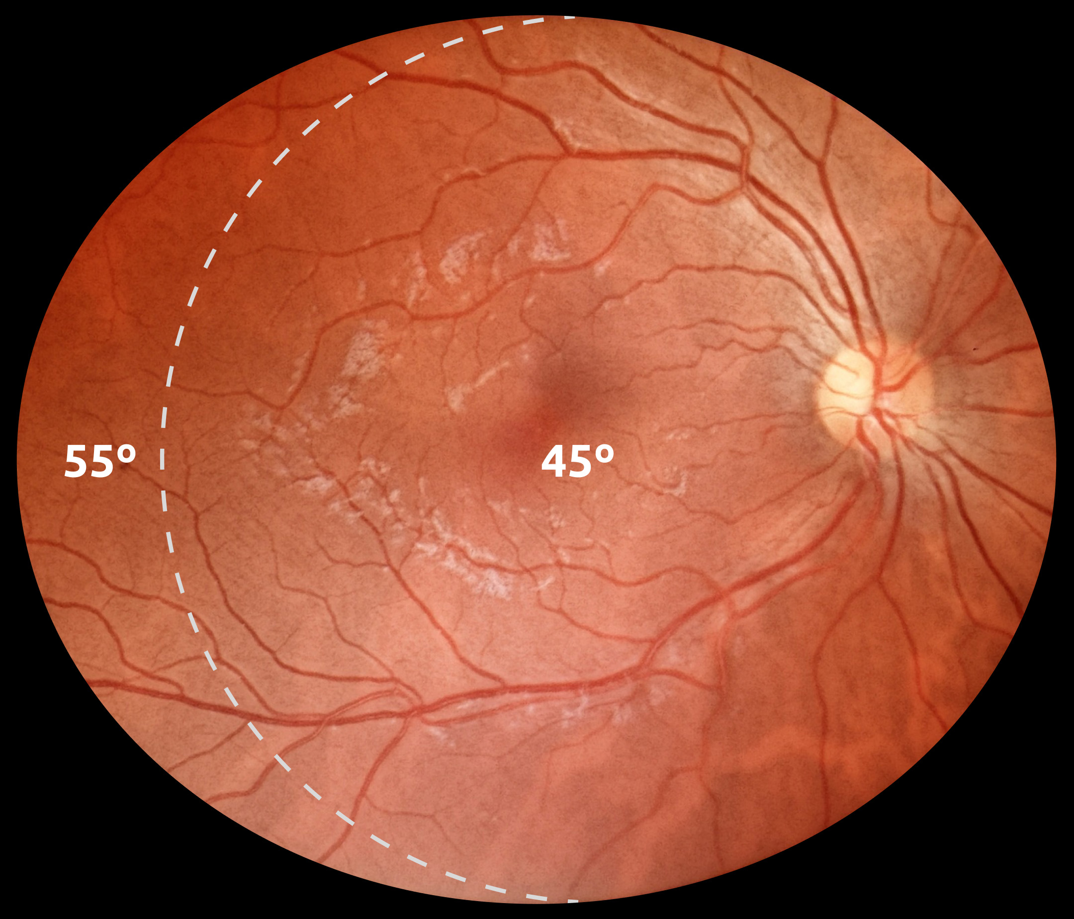 img_retina_55degrees_eyer2_fundus_camera Retina exam with 55º FOV capture by Eyer2 fundus camera.