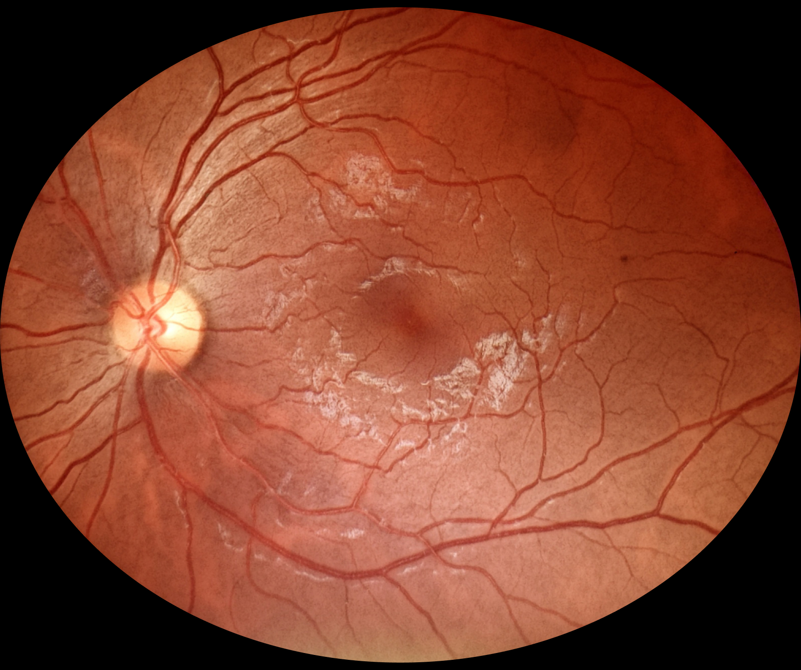 fundus_eyer2_1