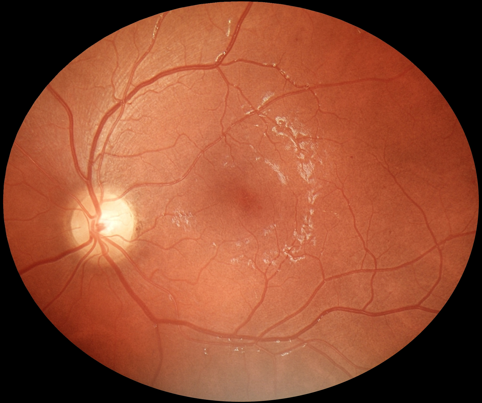 fundus_eyer2_2