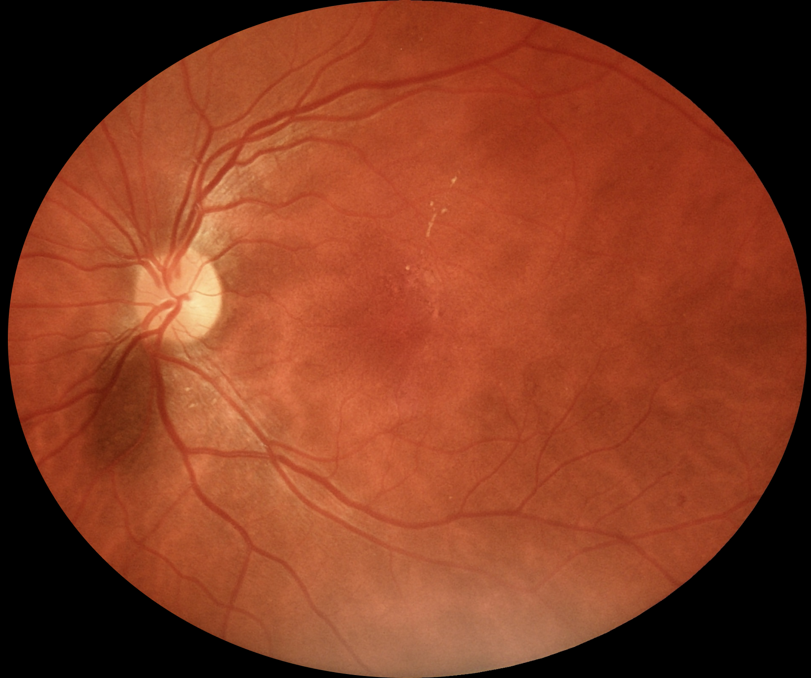 fundus_eyer2_3