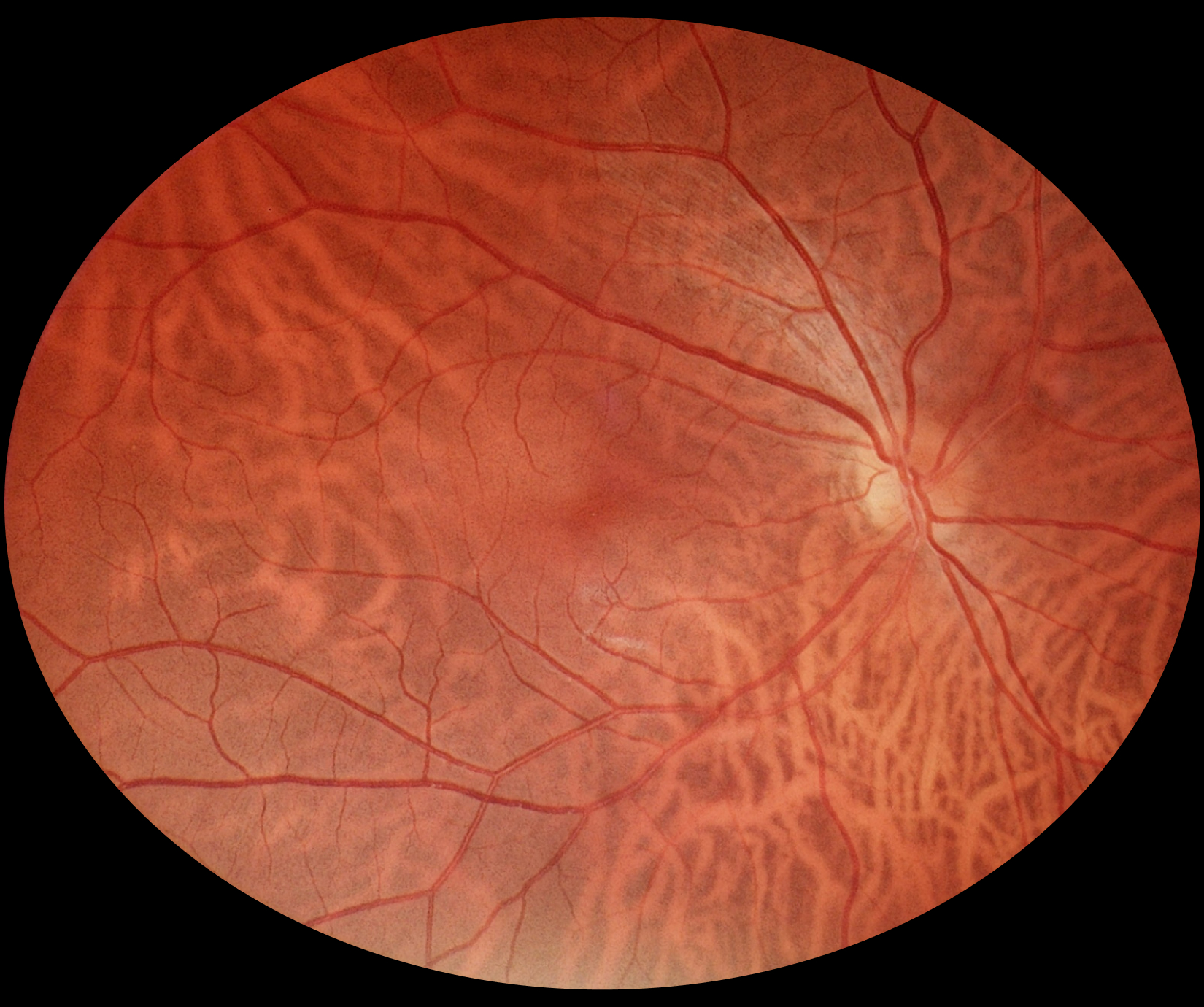 fundus_eyer2_5