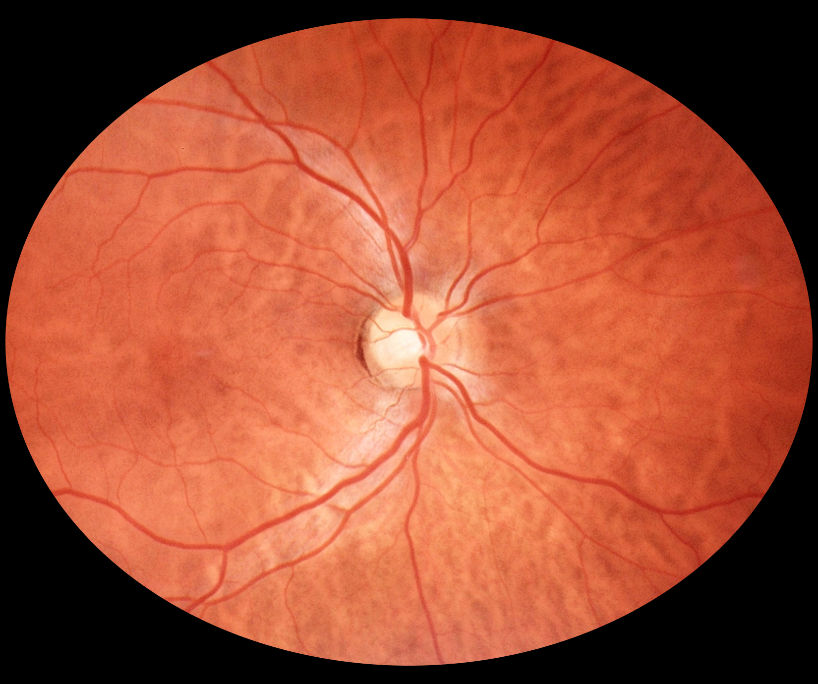 fundus_eyer2_6