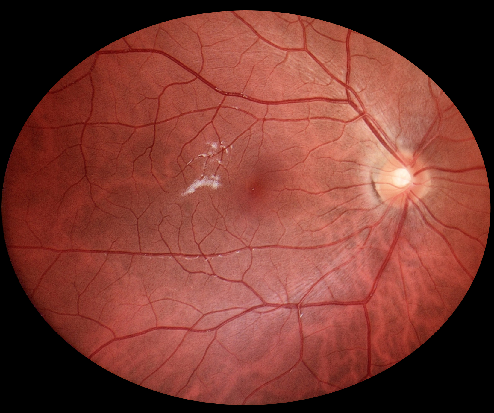fundus_eyer2_7