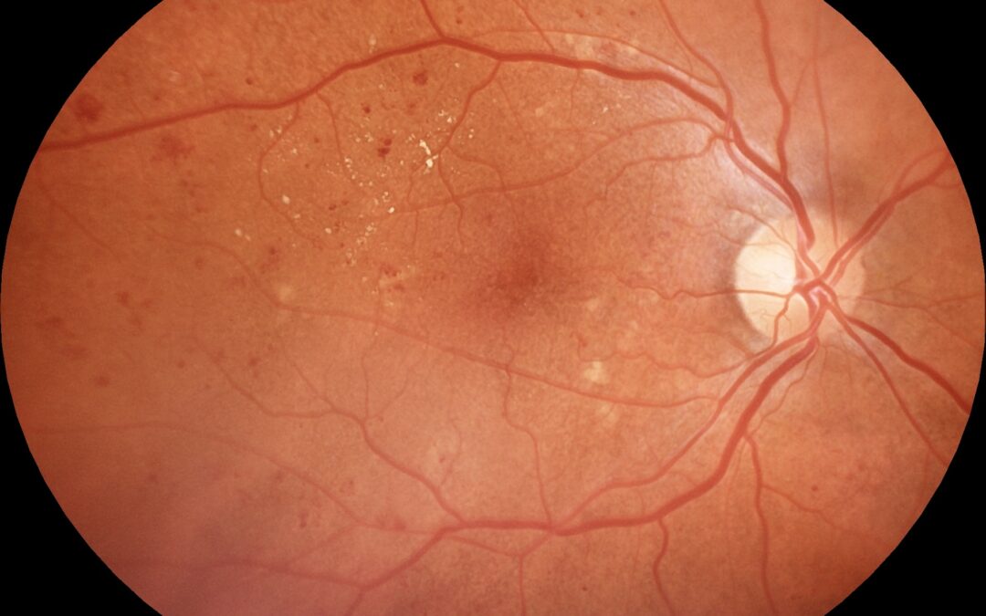 Como a retina pode mudar o tratamento do diabetes
