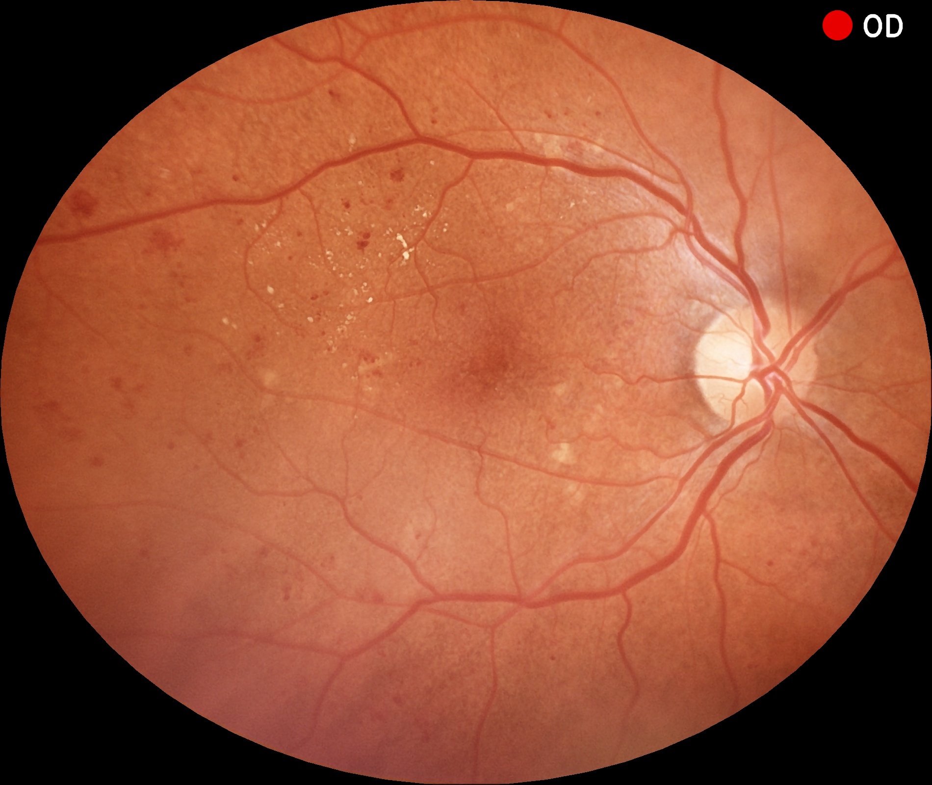 Retina com retinopatia diabética
